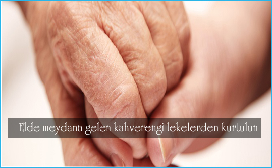 elde-meydana-gelen-kahverengi-lekelerden-kurtulun