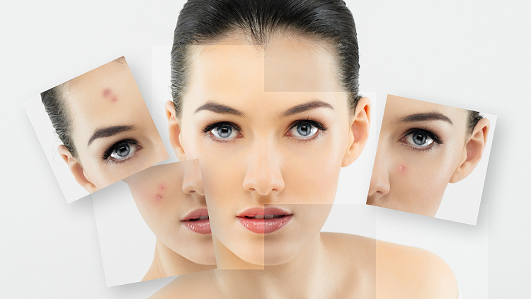 Comment-soigner-une-peau-grasse