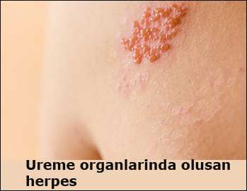 ureme-organlarinda-olusan-herpes flatcast tema