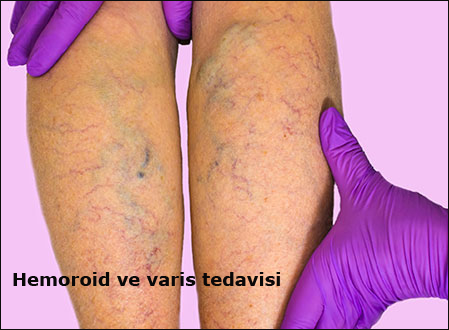 hemoroid-ve-varis-tedavisi flatcast tema